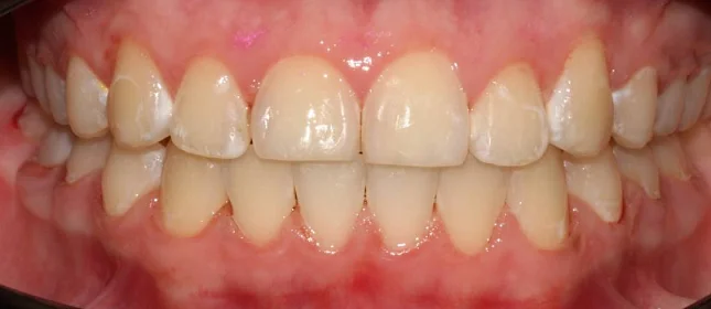 Ортодонтическое лечение на брекет-системе №3