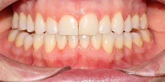 Лечение неправильного прикуса элайнерами