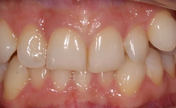 Ортодонтическое лечение на элайнерах