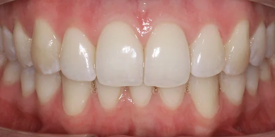 Расширение и выравнивание верхнего и нижнего зубных рядов