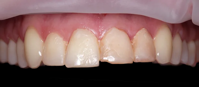 Устранение эстетического дефекта винирами