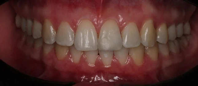 Лечение дистальной окклюзии на брекет-системе