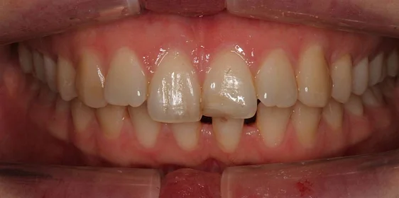 Лечение дистальной окклюзии на брекет-системе