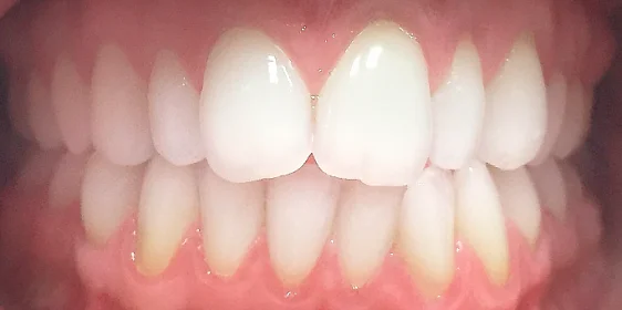 Выравнивание зубных рядов элайнерами Invisalign