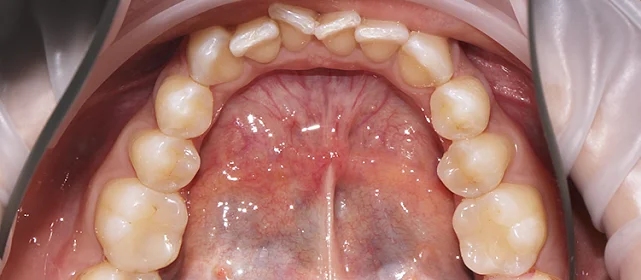 Исправление скученности