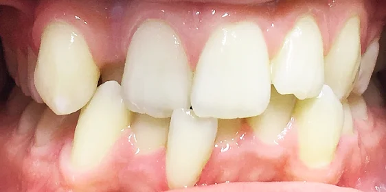 Завершающий этап лечения скученности и обратного перекрытия