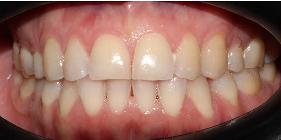 Ортодонтическое лечение на элайнерах