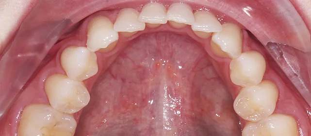 Коррекция смыкания элайнерами