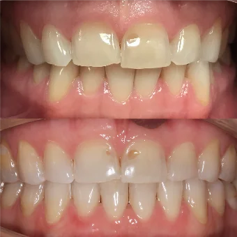 Нормализация смыкания и устранение скученности