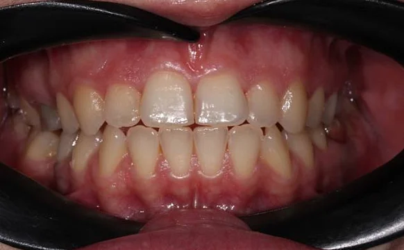 Лечение аномалии соотношений зубных дуг на элайнерах