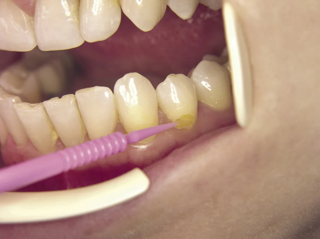 лечение гипоплазии эмали фото