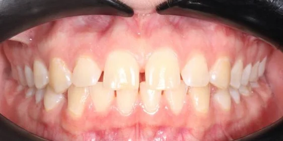 Лечение диастемы на верхней челюсти на элайнерах Click