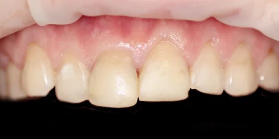 Протезирование зубов верхней челюсти винирами