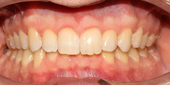 Ортодонтическое лечение на элайнерах