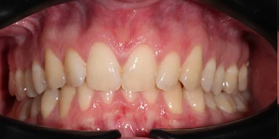 Установка ретейнеров на нижнюю и верхнюю челюсть