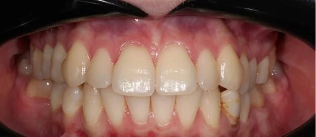 Лечение протрузии верхних резцов на брекет-системе