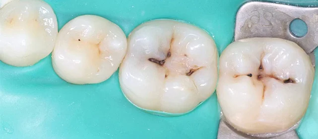 Эстетическая реставрация