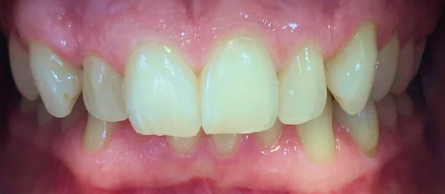 Ортодонтическое лечение №2