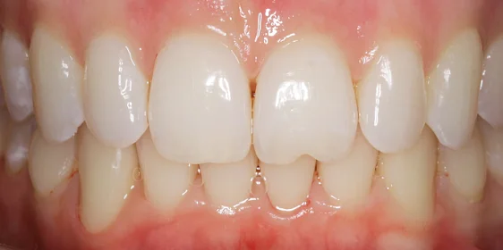 Лечение ретрузионного наклона верхних резцов с последующей реставрацией