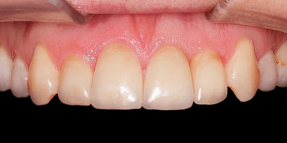 Восстановление эстетики с помощью виниров и вкладок (часть 1)