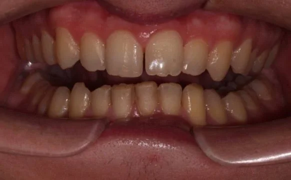 Ортодонтическое лечение на элайнерах