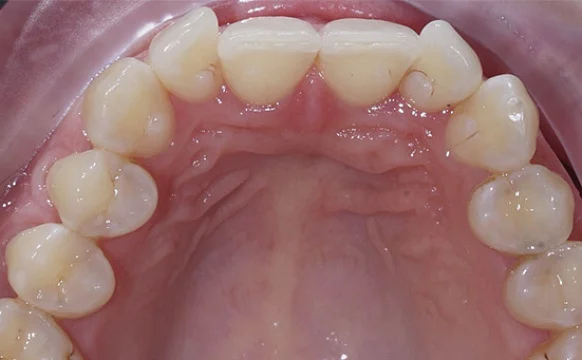 Изменение скученности зубов с помощью системы Invisalign