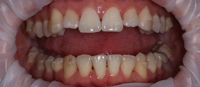 Профилактическая гигиена полости рта на этапе лечения на элайнерах