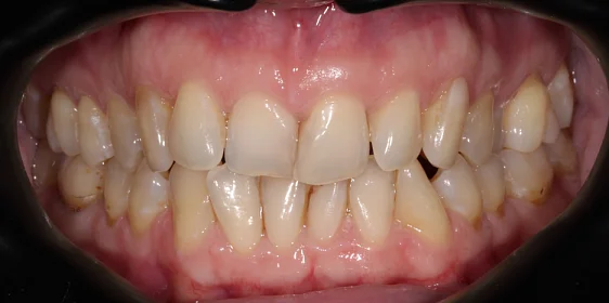 Коррекция аномалии соотношений зубных дуг элайнерами