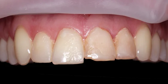 Устранение эстетического дефекта винирами