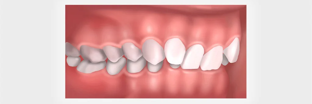 исправление глубокого прикуса фото