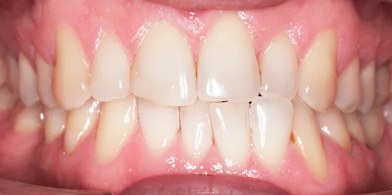 Исправление прикуса и имплантация