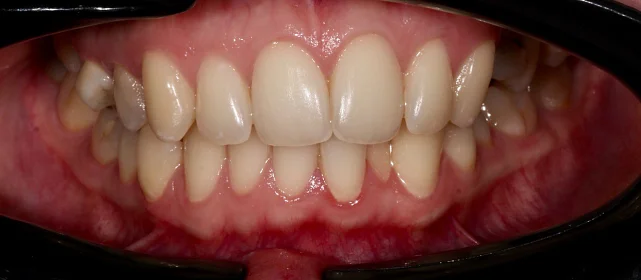 Лечение аномалии соотношения зубных дуг элайнерами