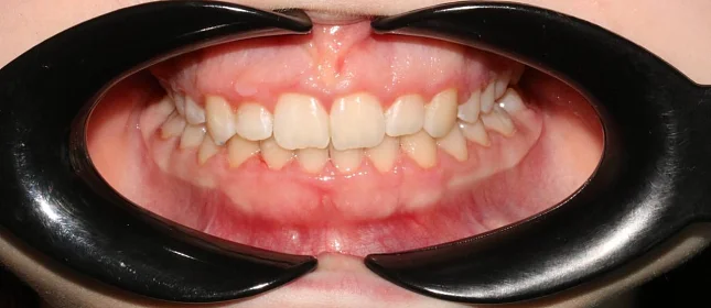 Лечение скученности зубов на брекет-системе