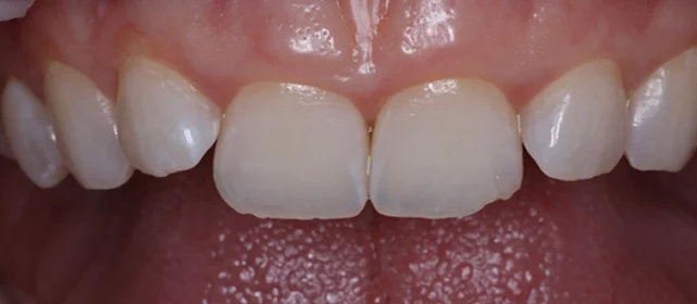 Реставрация переднего зуба