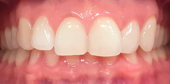 Исправление глубокого дистального прикуса