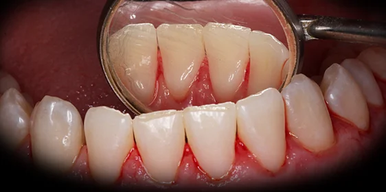 Снятие зубных отложений с помощью ультразвука и аппарата Air-Flow