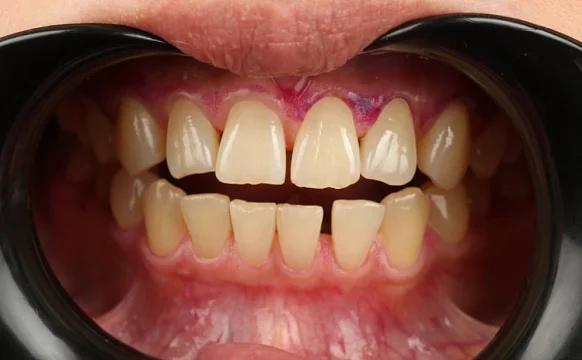 Ортодонтическое лечение на элайнерах №10