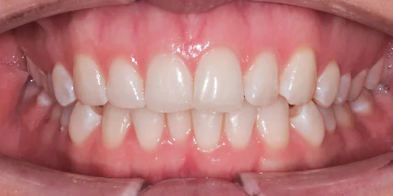 Исправление прикуса. 29 кап, 14 месяцев лечения