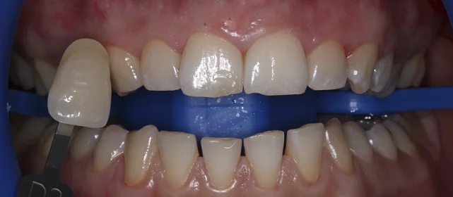 Отбеливание Zoom4