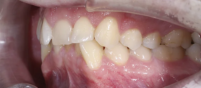 Исправление глубокого прикуса