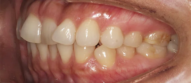 Исправление скученности, второго класса смыкания