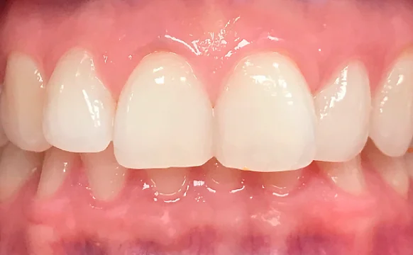 Исправление глубокого дистального прикуса