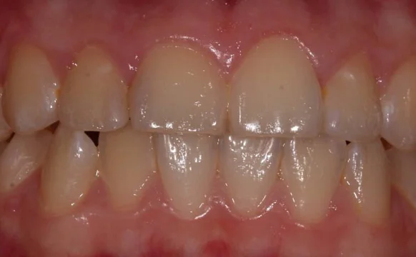 Ортодонтическое лечение на брекет-системе