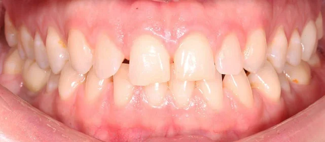 Ортодонтическое лечение с последующей ортопедией