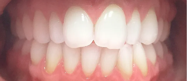 Выравнивание зубных рядов элайнерами Invisalign