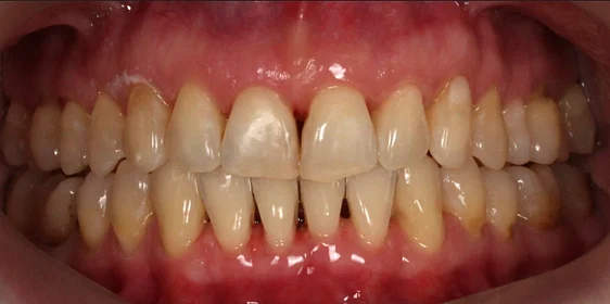 Коррекция аномалии соотношений зубных дуг элайнерами