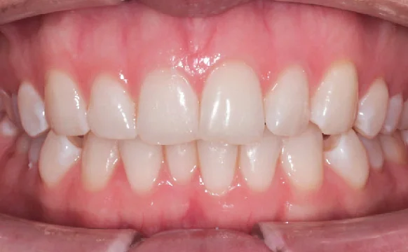 Исправление прикуса. 29 кап, 14 месяцев лечения