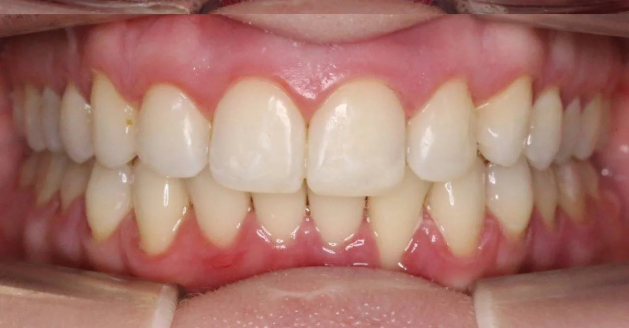 Лечение скученности зубов на элайнерах