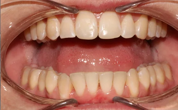 Лечение аномалии соотношения зубных дуг элайнерами