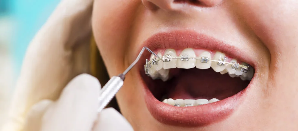 как выравнивают зубы